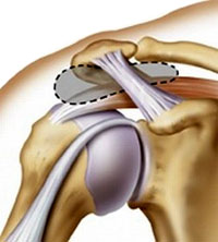 shoulder_surgery1